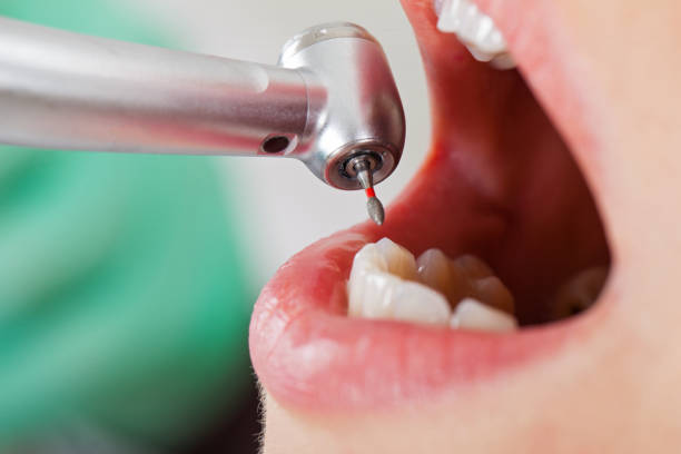 Best Knocked-Out Tooth (Avulsed Tooth) Treatment in Moorpark, CA